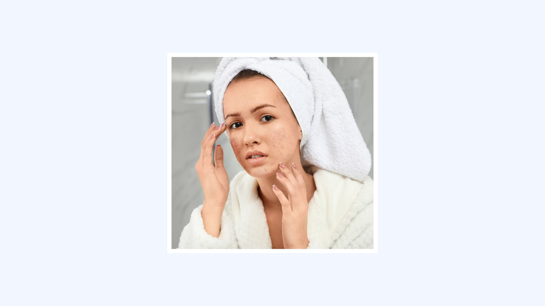 7 Types of Acne, Explained: Unraveling the Mystery of Blemishes