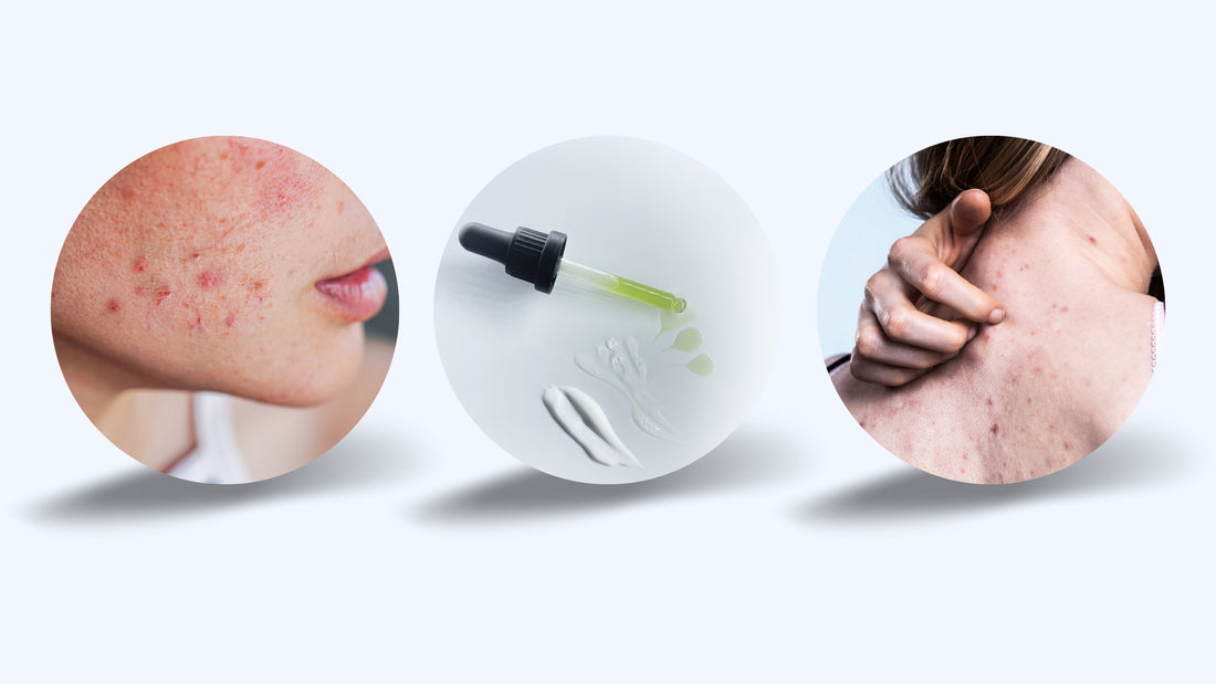 What is Fungal Acne?