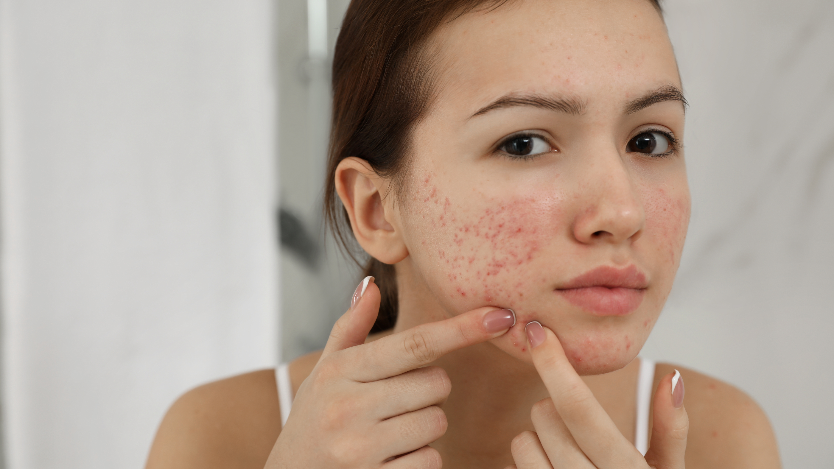 Dealing with Mouth Acne: Identifying Common Causes and Effective Solutions