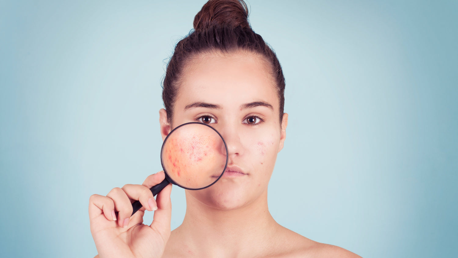 What's Cystic Acne?