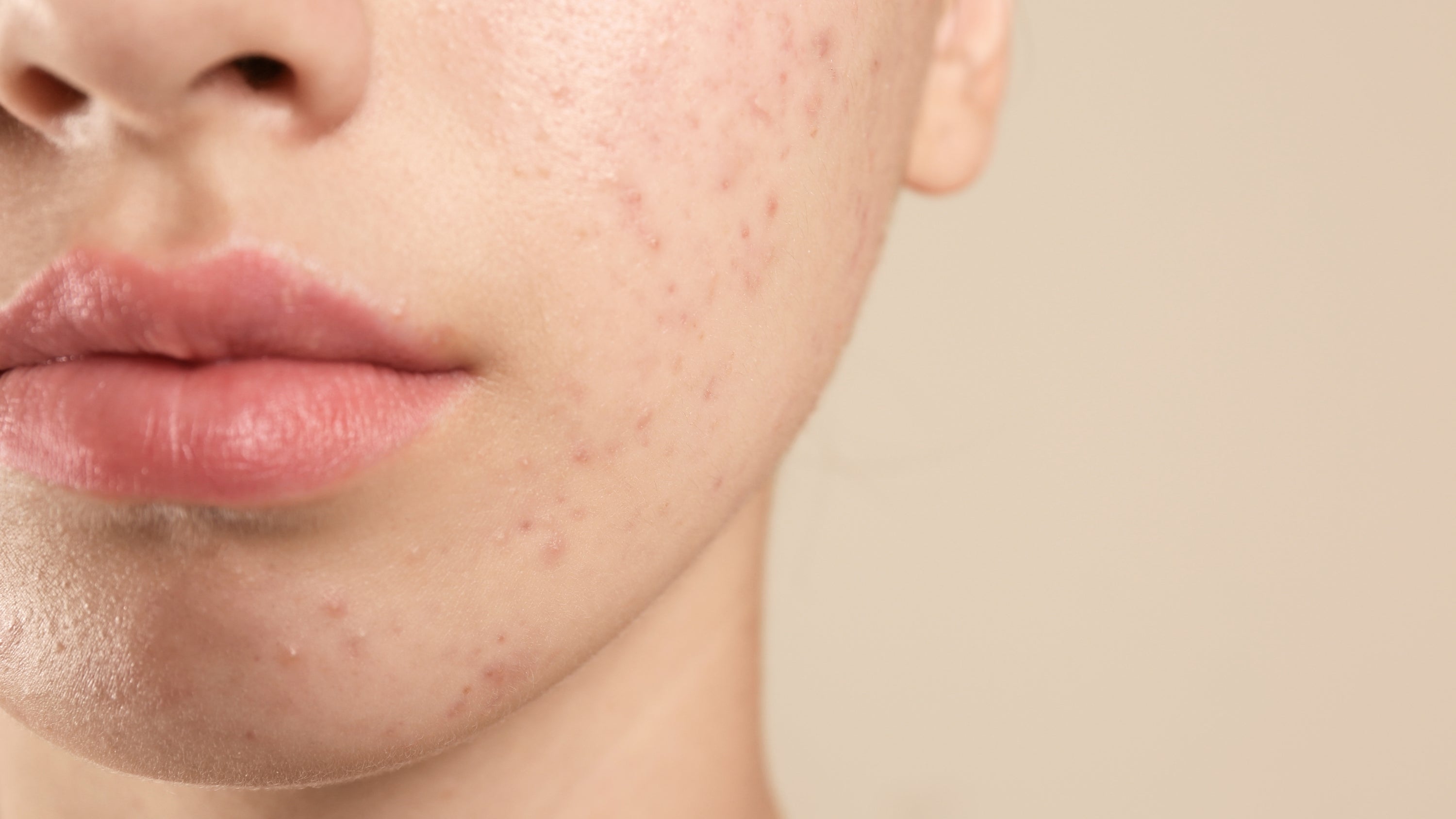 What Acne Treatment is Best for Sensitive Skin?
